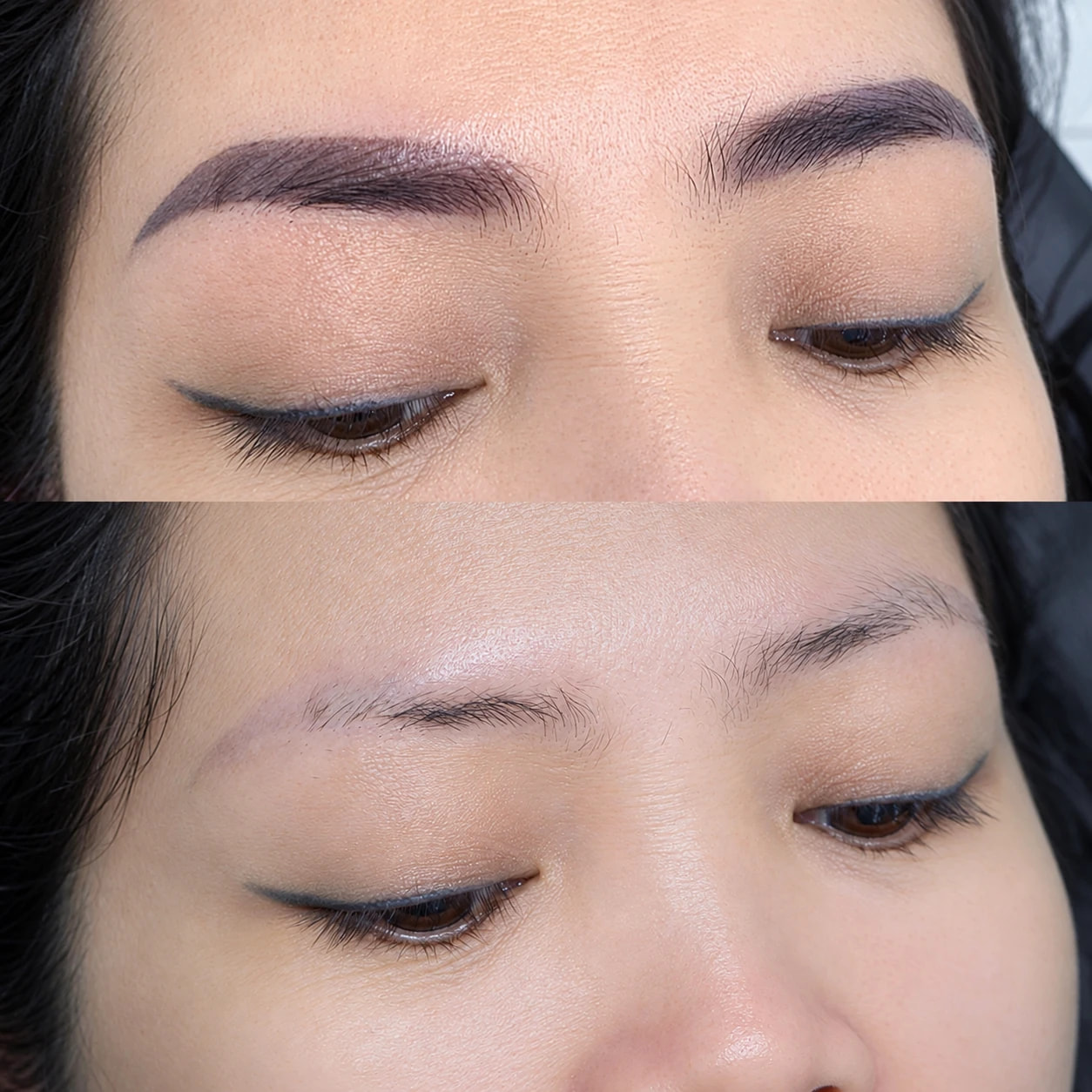 Laser Eyebrow Tattoo Removal